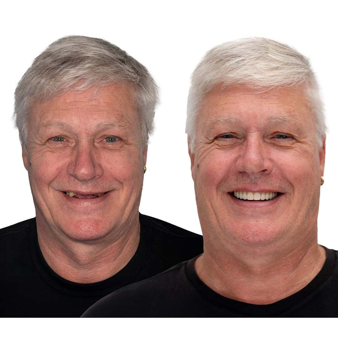 Removable Full-Arch Denture Set with Flexible Cushion Grip for Everyday Use